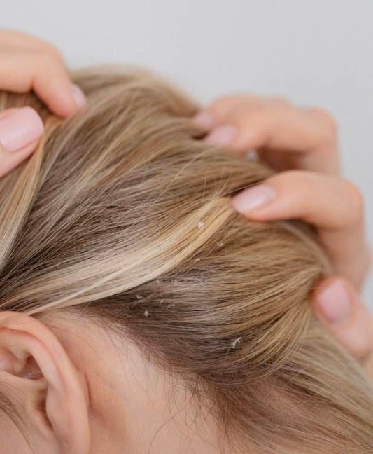 Come Prevenire la Forfora in Inverno: Consigli e Prodotti Naturali