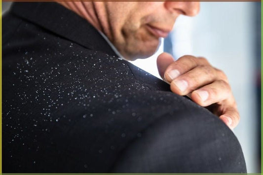 Come prevenire la forfora con prodotti naturali
